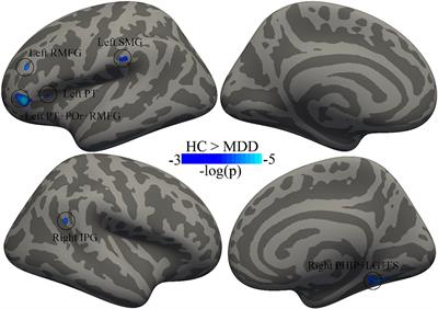 Regional decreases of cortical thickness in major depressive disorder and their correlation with illness duration: a case-control study